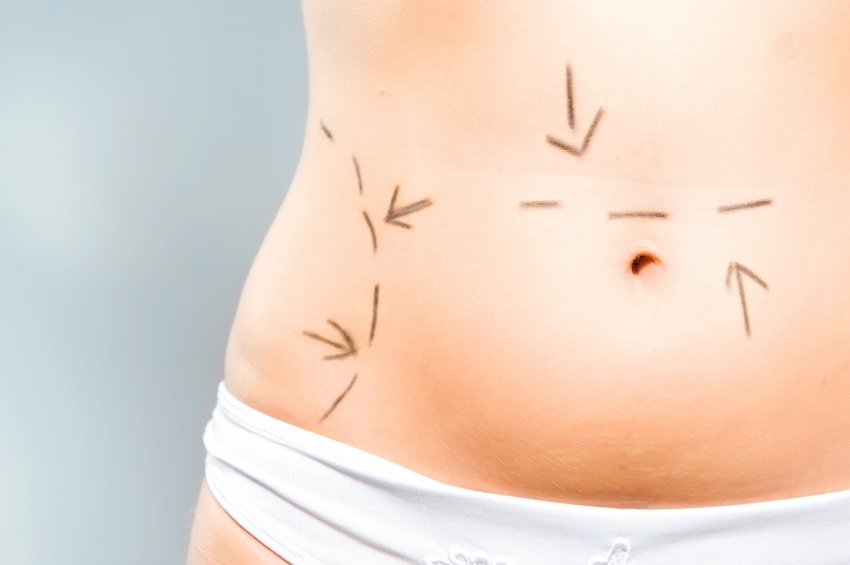 Marks on abdomen for cosmetic surgery